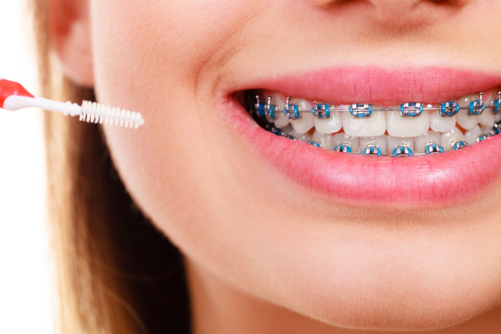 6 Tools for Cleaning Braces - Chelian Orthodontics