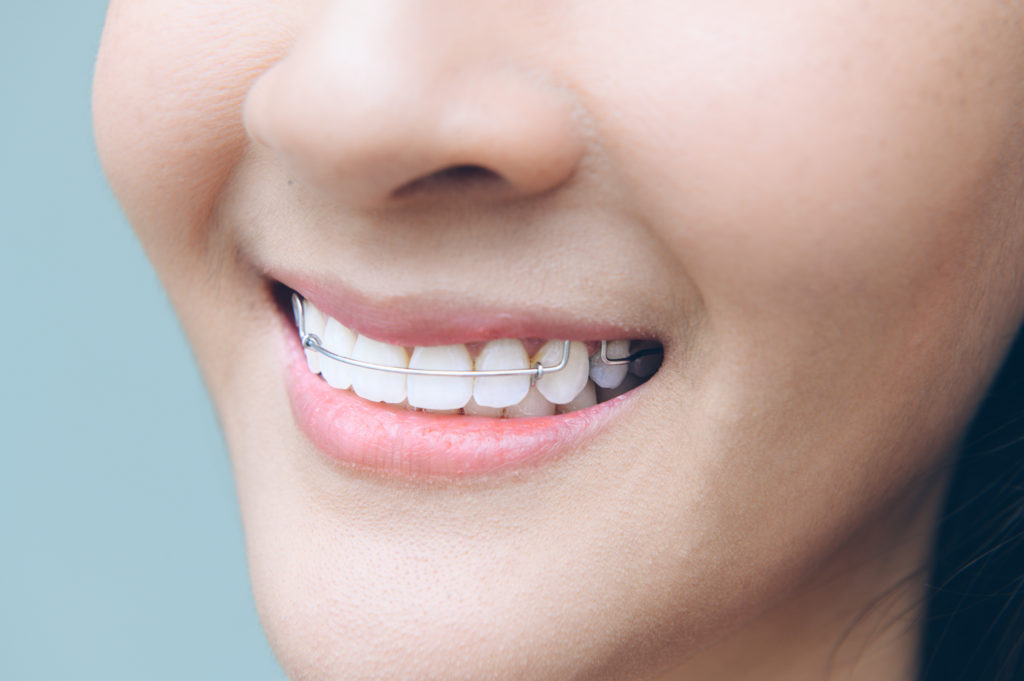 How Long Do Retainers Last Chelian Orthodontics